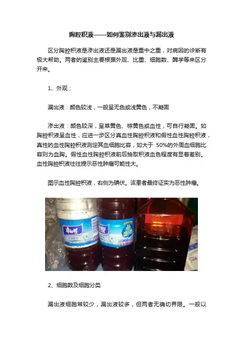 胸腔积液——如何鉴别渗出液与漏出液