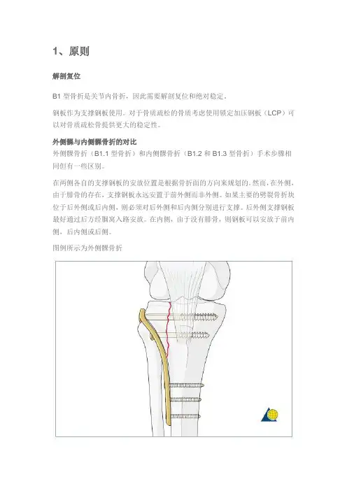 手术-胫骨平台B1型骨折内固定术