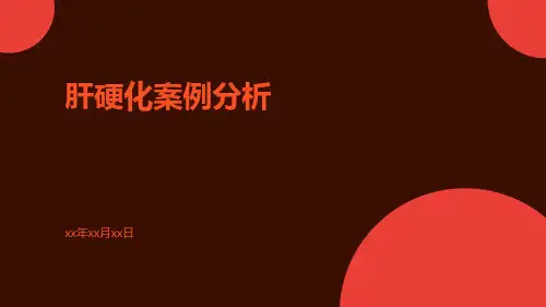 肝硬化案例分析版