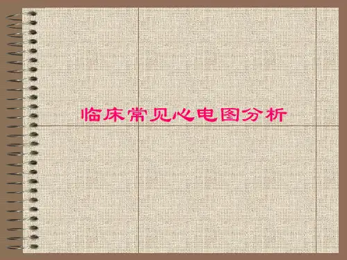 临床常见心电图分析 ppt课件