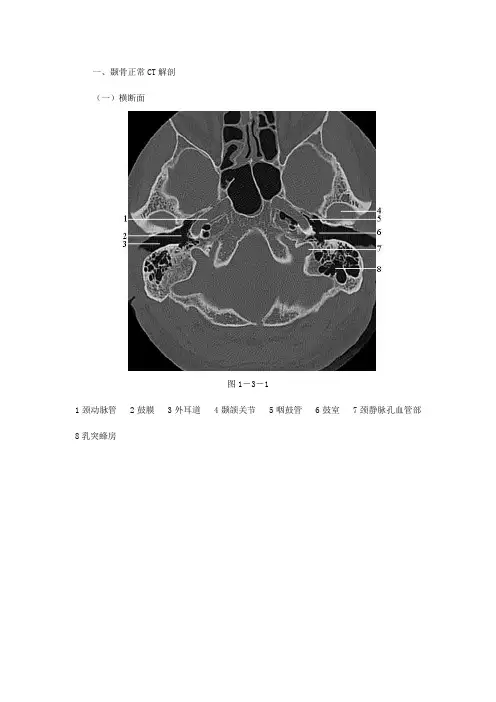 颞骨正常CT解剖(附图)