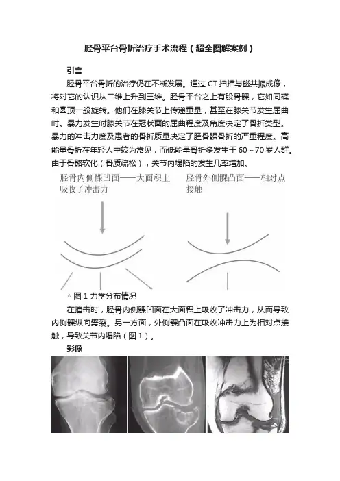 胫骨平台骨折治疗手术流程（?超全图解案例）