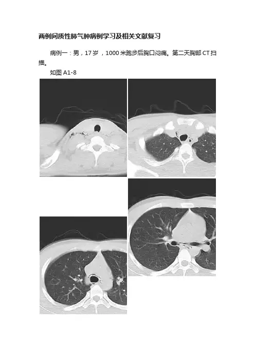 两例间质性肺气肿病例学习及相关文献复习