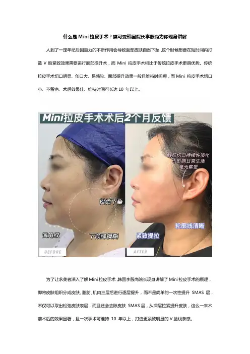 什么是Mini拉皮手术？蝶可变韩国院长李殷尚为你现身讲解