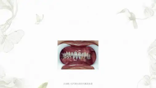 义齿戴入后可能出现的问题及处理ppt课件