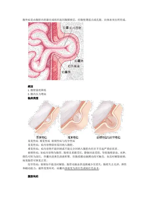 第三章病例分析——腹外疝