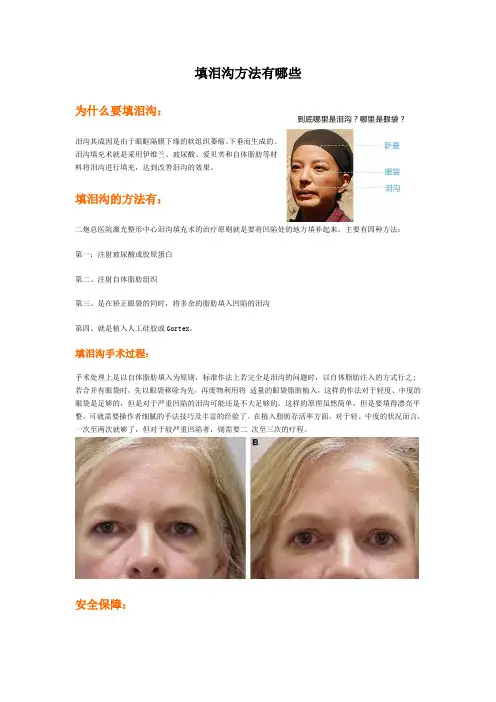 填泪沟方法有哪些