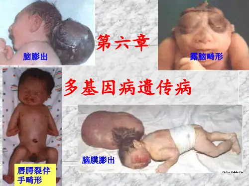 遗传学-第六章 多基因遗传病1.5h