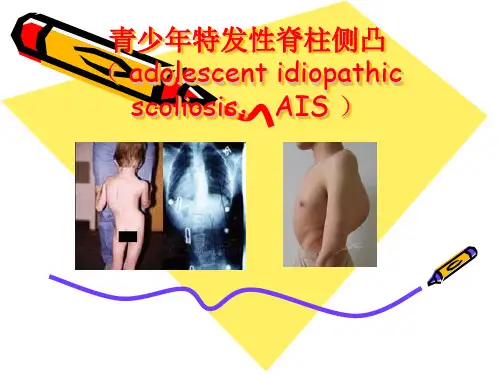青少年特发性脊柱侧凸
