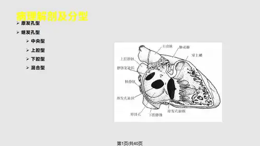 房间隔缺损介入治疗教学PPT课件