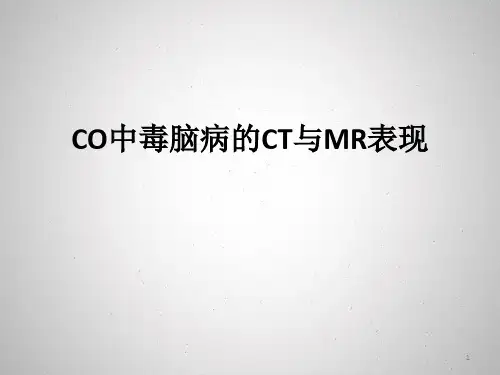 CO中毒脑病的CT与MR表现PPT课件