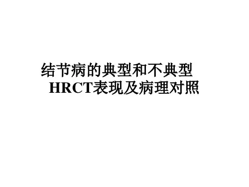 肺结节病的典型和不典型HRCT表现及病理对照