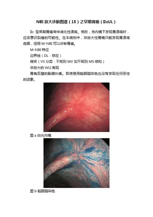 NBI放大诊断图谱（15）之早期胃癌（IIcUL）