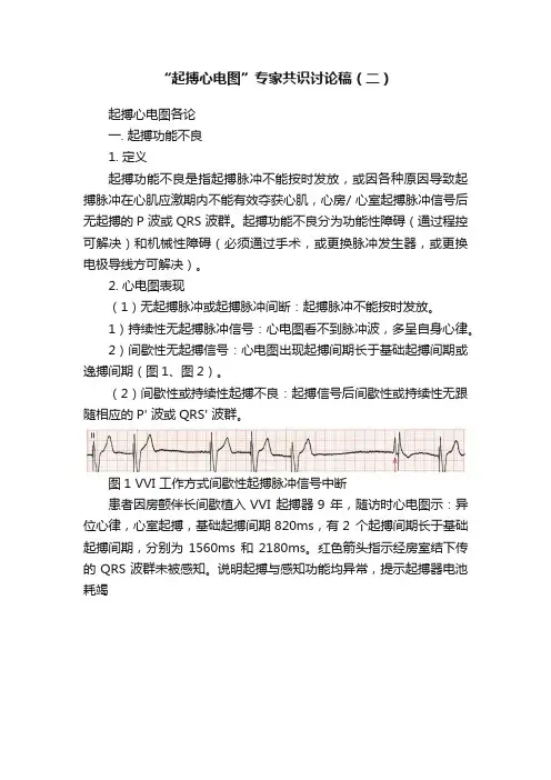 “起搏心电图”专家共识讨论稿（二）