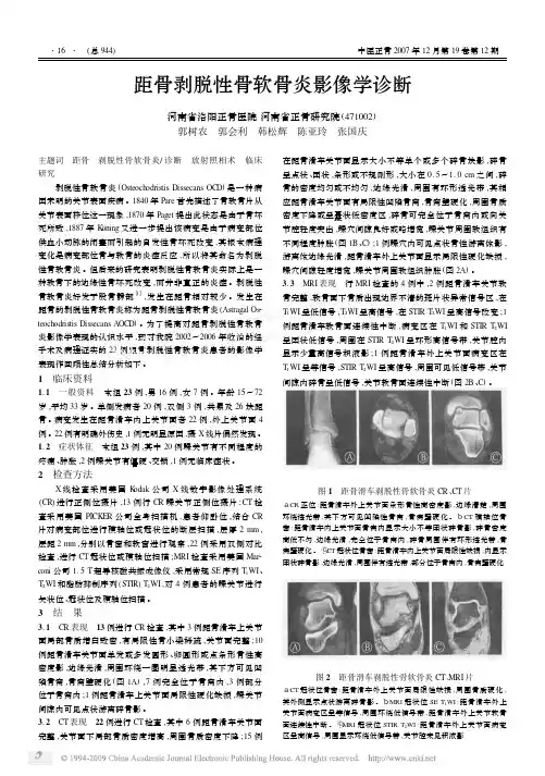 距骨剥脱性骨软骨炎影像学诊断