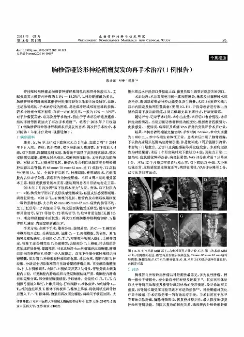 胸椎管哑铃形神经鞘瘤复发的再手术治疗(1例报告)