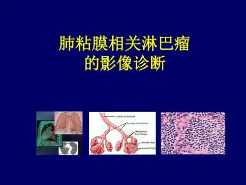 肺粘膜相关淋巴瘤的影像学诊断