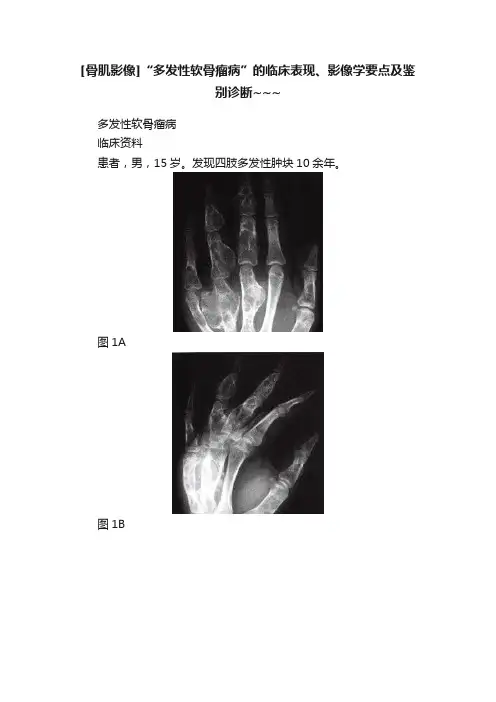 [骨肌影像]“多发性软骨瘤病”的临床表现、影像学要点及鉴别诊断~~~