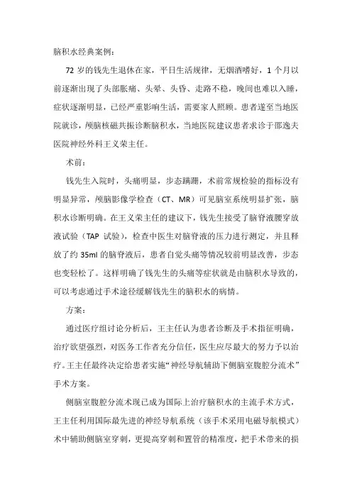 脑积水经典案例