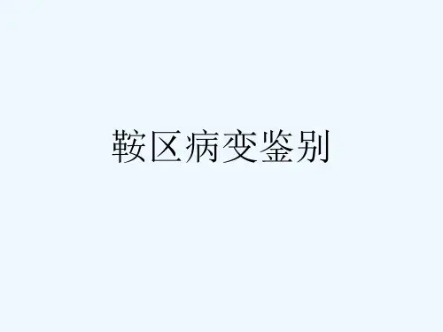 鞍区病变鉴别[可修改版ppt]