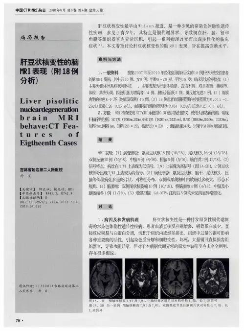 肝豆状核变性的脑MRI表现(附18例分析)