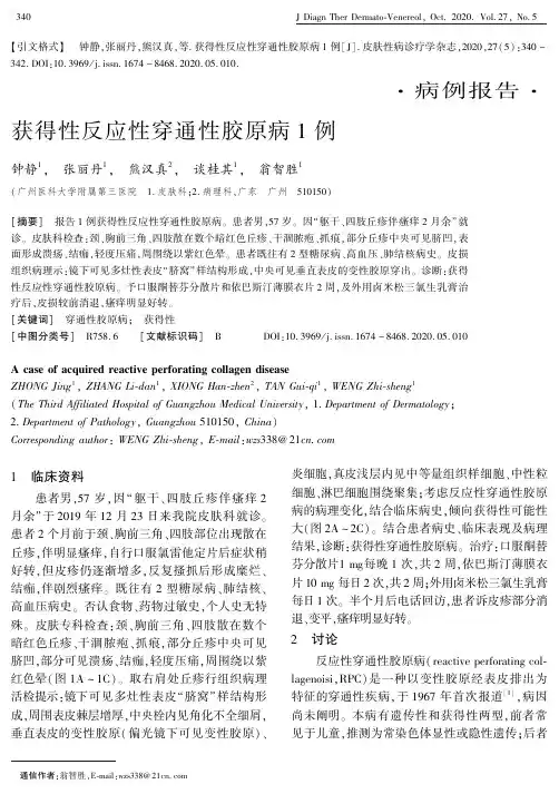 获得性反应性穿通性胶原病1例