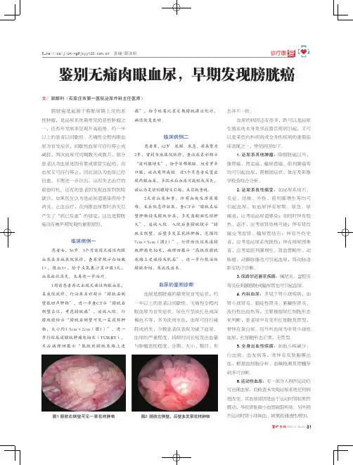 鉴别无痛肉眼血尿,早期发现膀胱癌