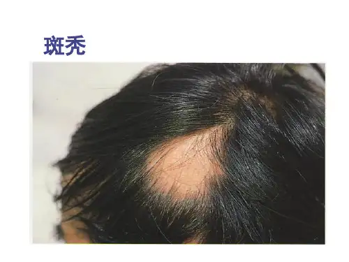 《斑秃的治疗》PPT课件