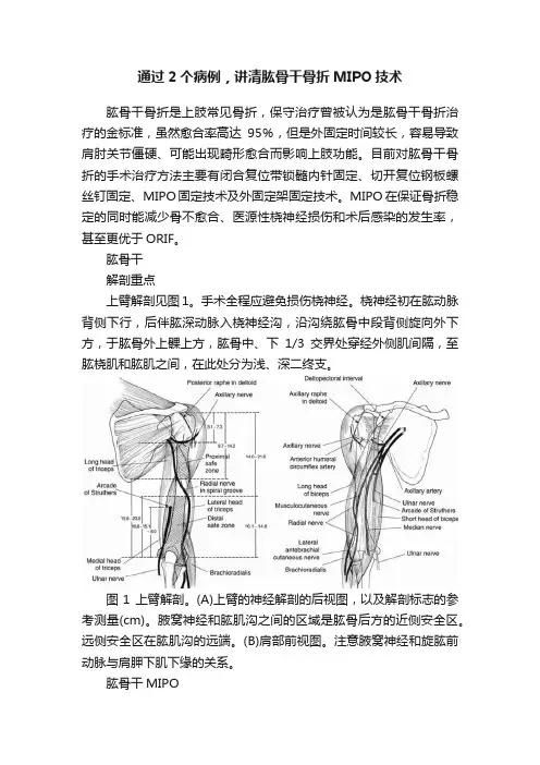 通过2个病例，讲清肱骨干骨折MIPO技术