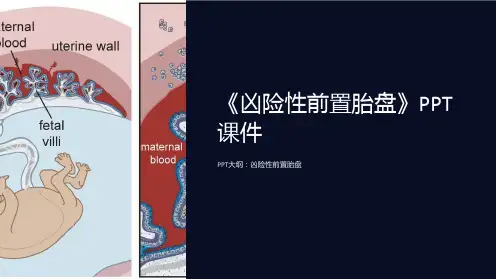 《凶险性前置胎盘》课件