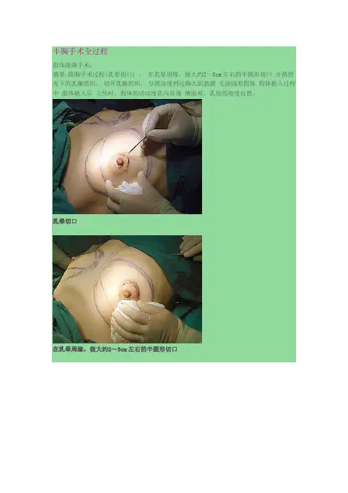 丰胸手术全过程