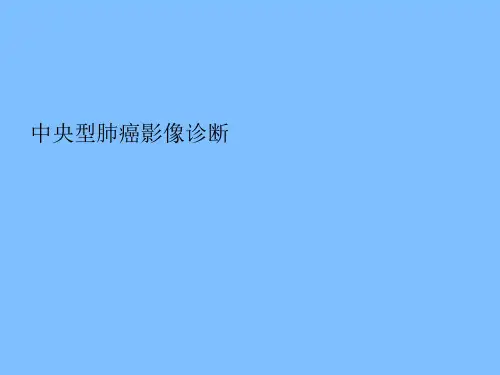 中央型肺癌 影像诊断