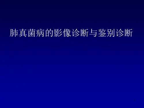 肺曲霉菌病的影像学诊断与鉴别诊断ppt课件