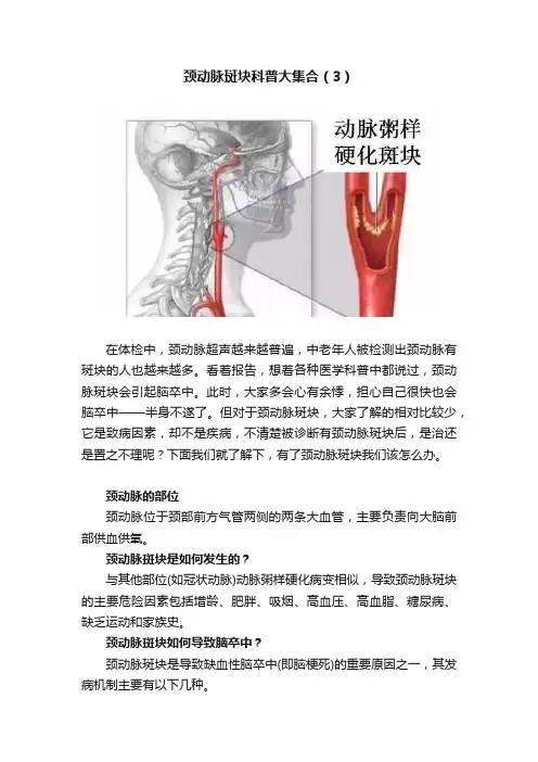 颈动脉斑块科普大集合（3）