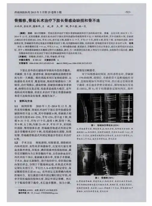 骨搬移、骨延长术治疗下肢长骨感染缺损和骨不连