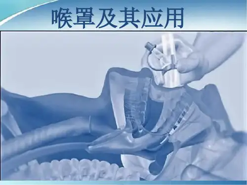 喉罩