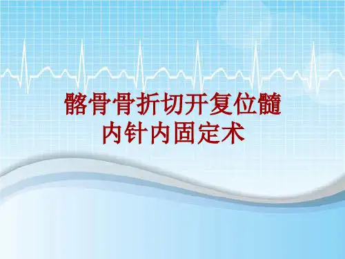 手术讲解模板：髂骨骨折切开复位髓内针内固定术