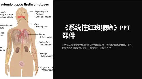 《系统性红斑狼疮》课件
