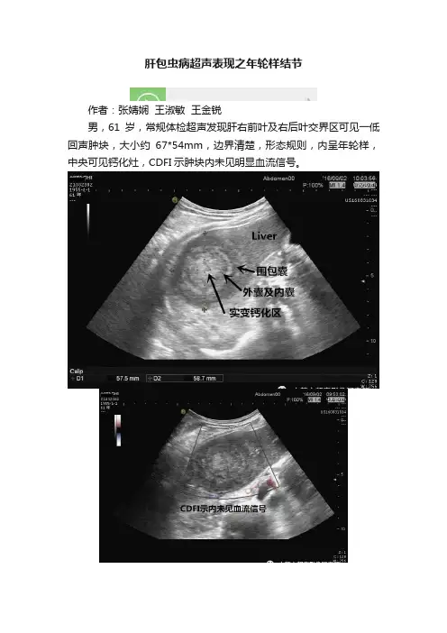 肝包虫病超声表现之年轮样结节