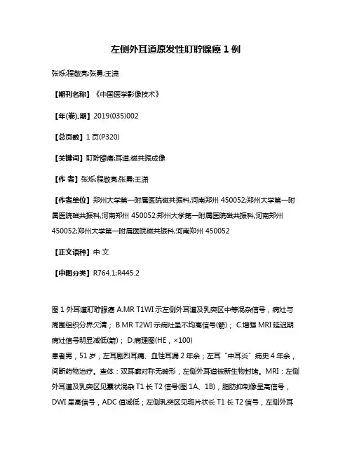 左侧外耳道原发性耵聍腺癌1例
