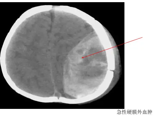 脑外伤典型病例