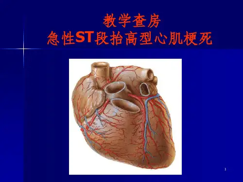 教学查房(急性心肌梗死)