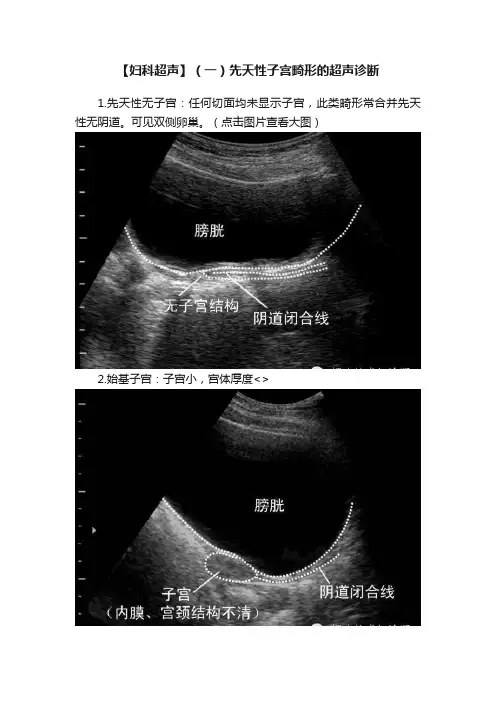 【妇科超声】（一）先天性子宫畸形的超声诊断