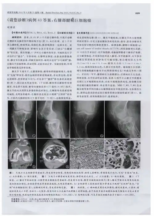 《请您诊断》病例43答案：右膝部腱鞘巨细胞瘤