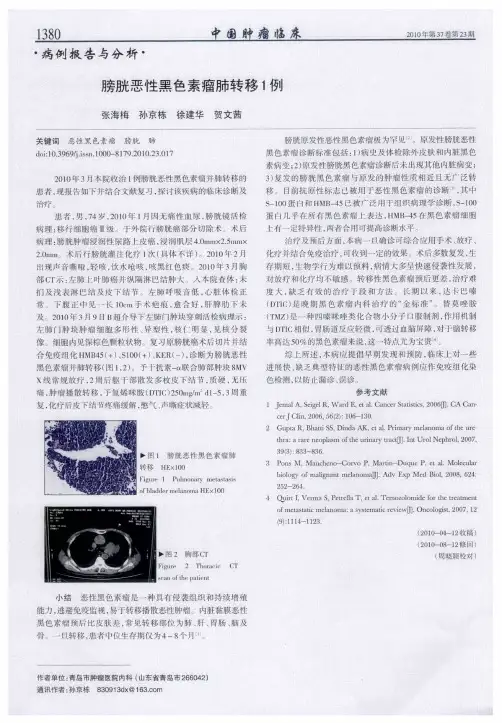 膀胱恶性黑色素瘤肺转移1例