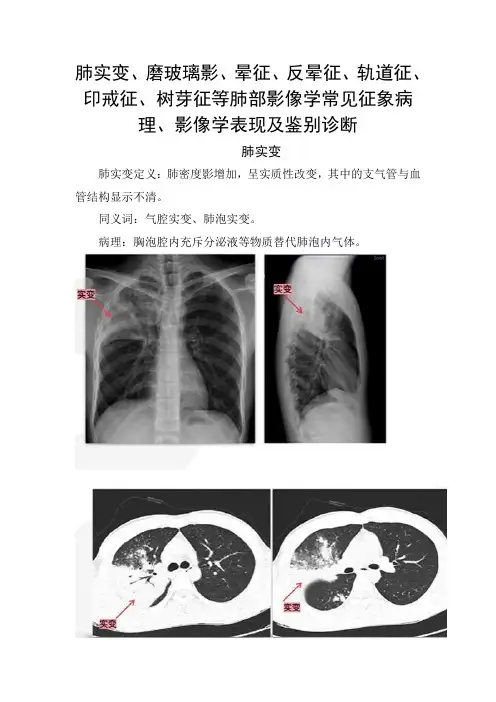 肺实变、磨玻璃影、晕征、反晕征、轨道征、印戒征、树芽征等肺部影像学常见征象病理、影像学表现及鉴别诊断