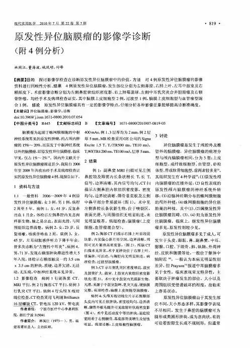 原发性异位脑膜瘤的影像学诊断(附4例分析)