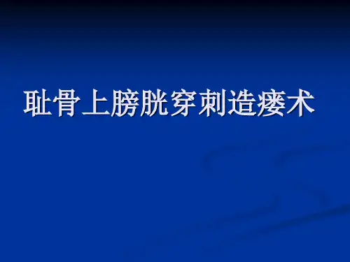 耻骨上膀胱穿刺造瘘术