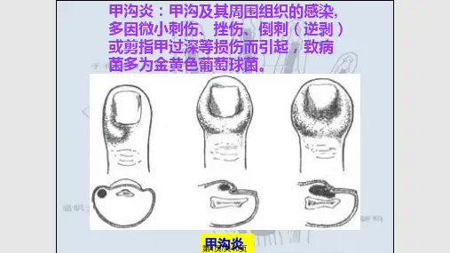 手部的化脓性感染PPT课件