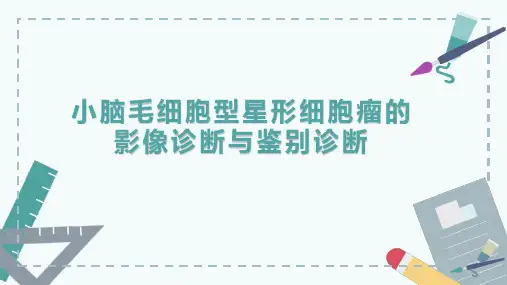 小脑毛细胞型星形细胞瘤的影像诊断与鉴别诊断